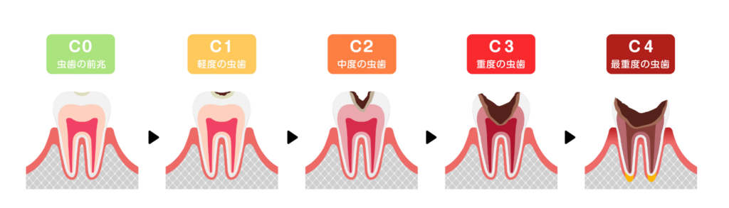 虫歯の進行｜宮本医院の歯科