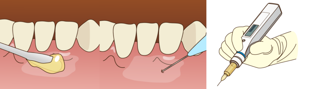 痛みを極限まで抑えた治療｜宮本医院の歯科