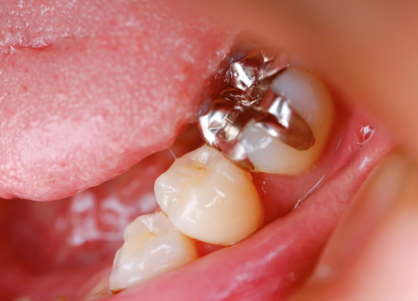 保険診療の素材｜宮本医院の歯科