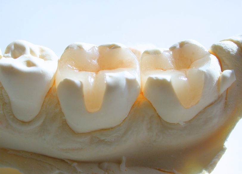 自由診療の素材｜宮本医院の歯科