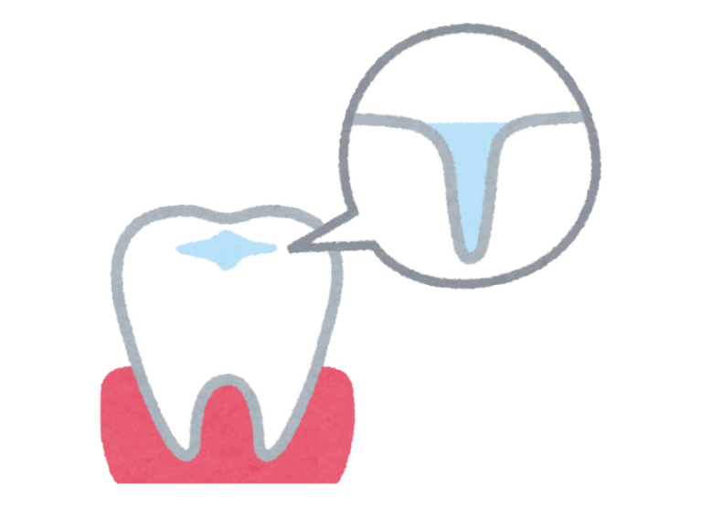 シーラント｜宮本医院の歯科