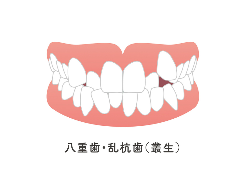 叢生｜宮本医院の歯科