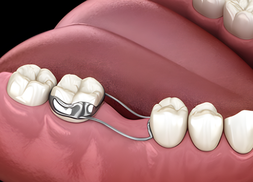 スペースメインテナー｜宮本医院の歯科