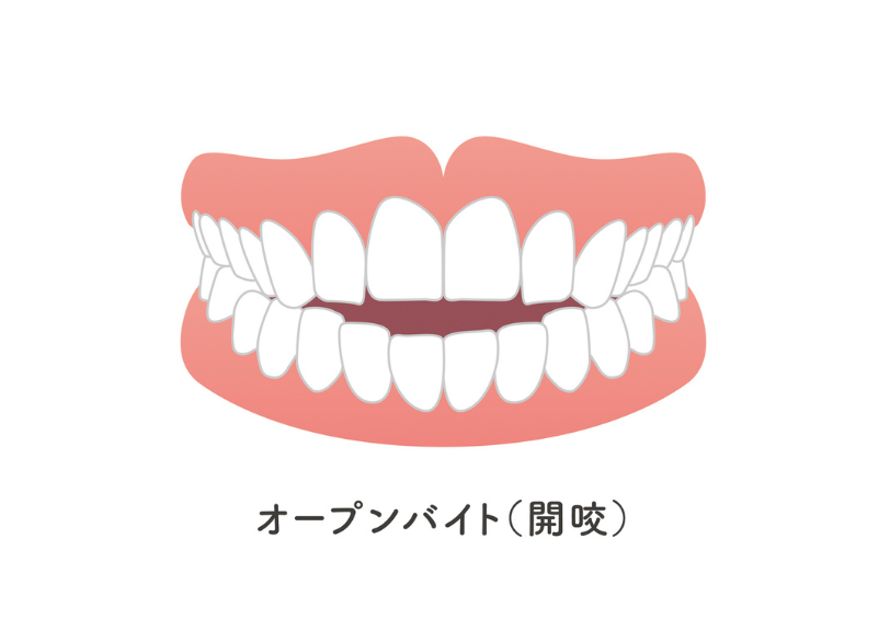開咬｜宮本医院の歯科