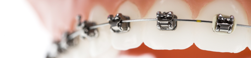 矯正治療の流れ｜宮本医院の歯科