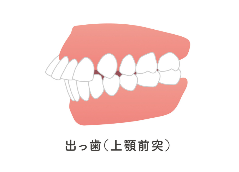 出っ歯｜宮本医院の歯科