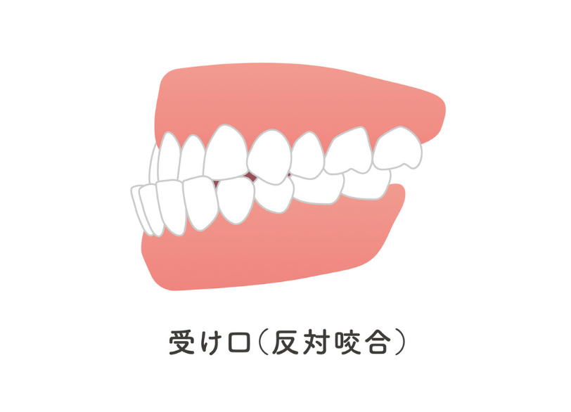 受け口｜宮本医院の歯科