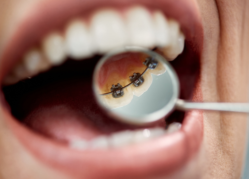 リンガルブラケット｜宮本医院の歯科