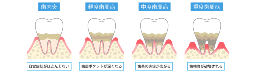歯周病はいつの間にか進行していきます｜宮本医院の歯科