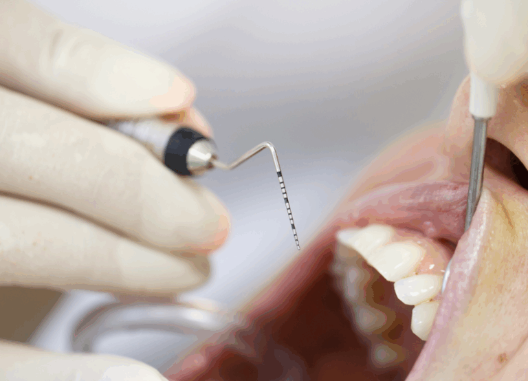 歯周ポケット検査｜宮本医院の歯科