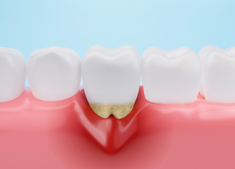 歯を失う原因第１位｜宮本医院の歯科