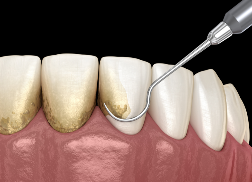 歯肉キュレット｜宮本医院の歯科