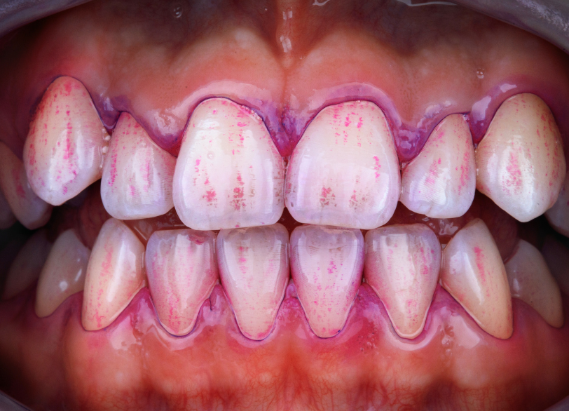 口腔内検査・染め出し｜宮本医院の歯科