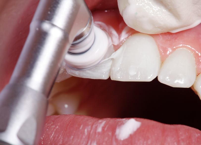 ポリッシング（研磨）｜宮本医院の歯科