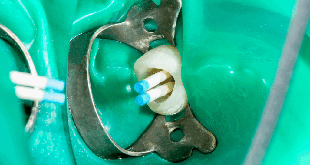 根管充填|宮本医院の歯科