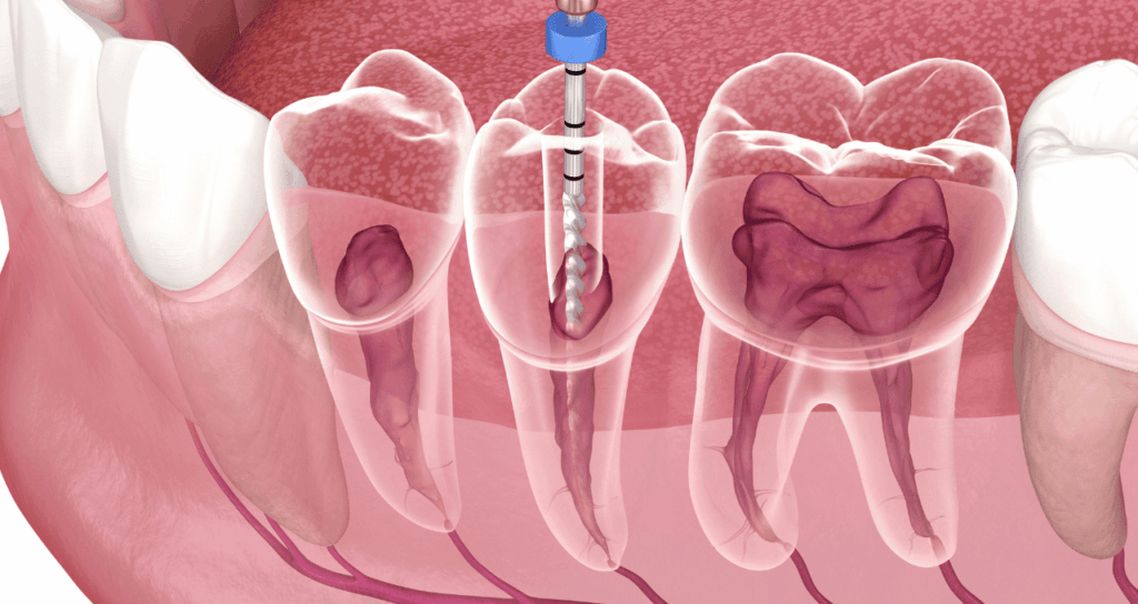 根管治療は難しい|宮本医院の歯科