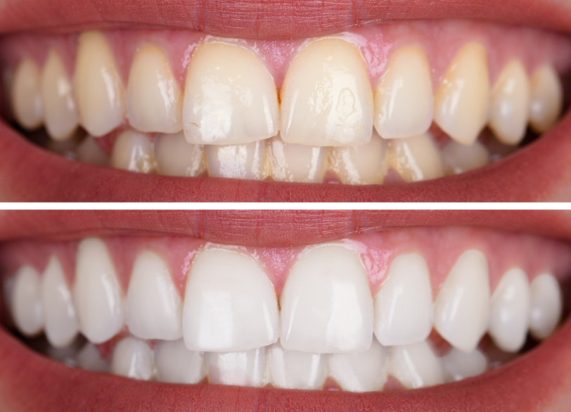 デュアルホワイトニング｜宮本医院の歯科