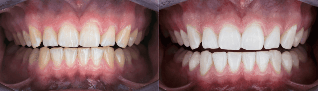 ホワイトニングのメカニズム｜宮本医院の歯科