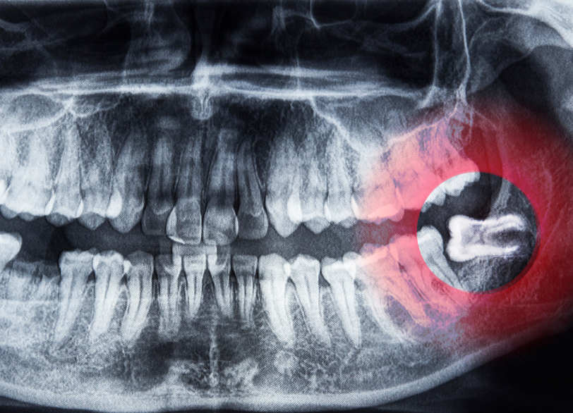 親知らずの抜歯｜宮本医院の歯科